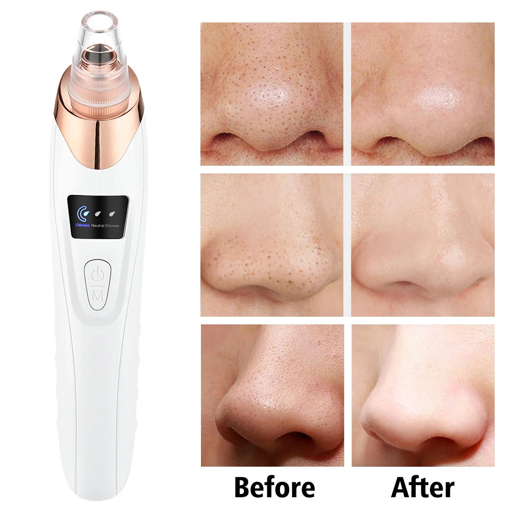“Blackhead Vacuum Remover – Facial Pore Cleaner”