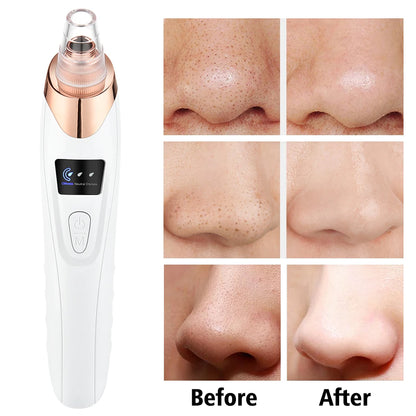 “Blackhead Vacuum Remover – Facial Pore Cleaner”